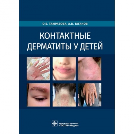 Отдельные виды заболеваний у детей, книга Контактные дерматиты у детей купить по скидке